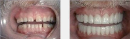 Veneers verdecken Zahnlücke Veneers verdecken Zahnlücke