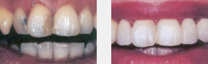 Aufgesetzte Veneers Aufgesetzte Veneers