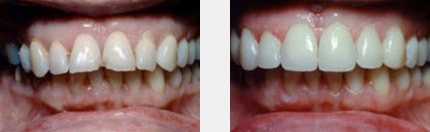 Ästhetisches Veneering - Zahnarzt Braunschweig Ästhetisches Veneering - Zahnarzt Braunschweig