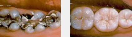 Ästhetische Vollkeramikkronen Ästhetische Vollkeramikkronen