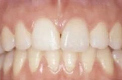 Dunklen Zahn durch Bleaching behandelt