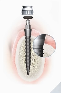 Detailansicht eines Mini-Implantats