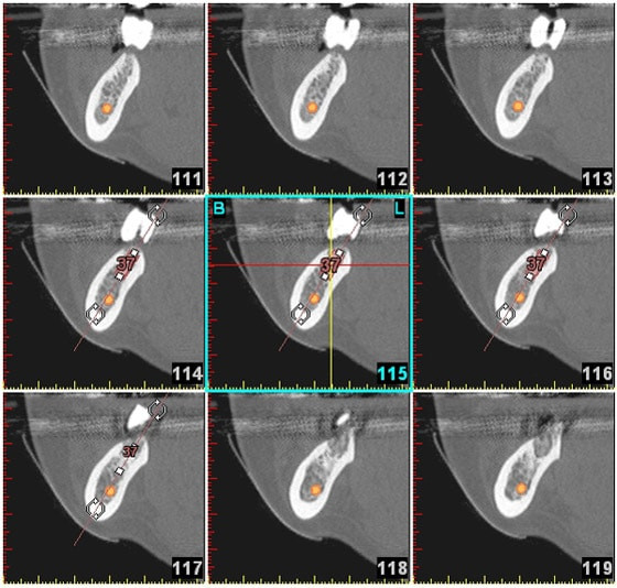 3D-Planung bei komplexen Implantationen 3D-Planung bei komplexen Implantationen