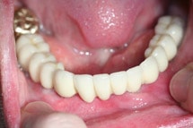 Implantatgetragener Zahnersatz - Zahnarzt Braunschweig