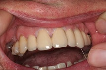 Zahnersatz für Einzelzähne