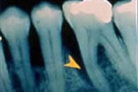 Röntgenbild zeigt fortgeschrittene Parodontitis