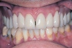 Herausnehmbarer Zahnersatz - Zahnarztpraxis Braunschweig